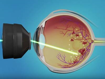 Trattamento laser sulla retina di un prematuro all’Umberto I di Enna – video