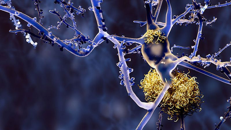 Alzheimer, Roche conferma il suo impegno in ricerca e sviluppo